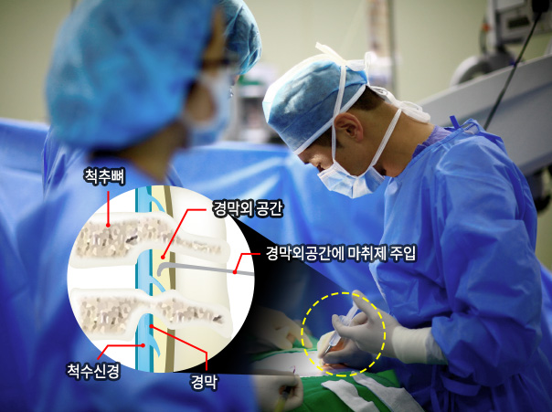 경막외공간에 마취제 주입