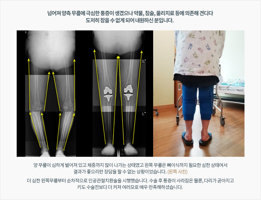 넘어져 양측 무릎에 극심한 통증이 생겼으나 약물, 침술, 물리치료 등에 의존해 견디다 도저히 참을 수 없게 되어 내원하신 분입니다. 양 무릎이 심하게 벌어져 있고 체중까지 많이 나가는 상태였고 왼쪽 무릎은 뼈이식까지 필요한 심한 상태여서 결과가 좋으리란 장담을 할 수 없는 상황이었습니다. (왼쪽 사진) 더 심한 왼쪽무릎부터 순차적으로 인공관절치환술을 시행했습니다. 수술 후 통증이 사라짐은 물론, 다리가 곧아지고 키도 수술전보다 더 커져 여러모로 매우 만족해하셨습니다.