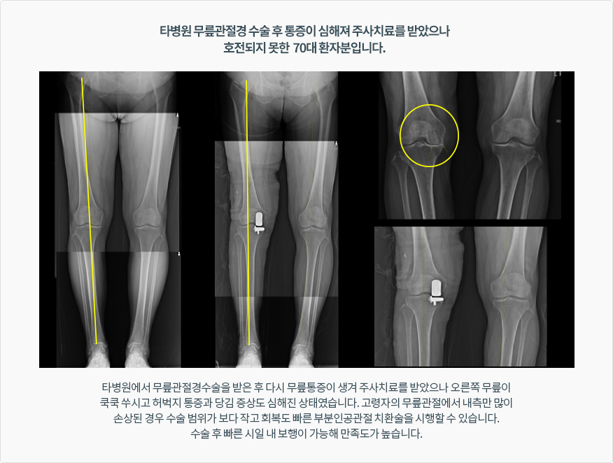 타병원 무릎관절경 수술 후 통증이 심해져 주사치료를 받았으나 호전되지 못한 70대 환자분입니다. 타병원에서 무릎관절경수술을 받은 후 다시 무릎통증이 생겨 주사치료를 받았으나 오른쪽 무릎이 쿡쿡 쑤시고 허벅지 통증과 당김 증상도 심해진 상태였습니다. 고령자의 무릎관절에서 내측만 많이 손상된 경우 수술 범위가 보다 작고 회복도 빠른 부분인공관절 치환술을 시행할 수 있습니다. 수술 후 빠른 시일 내 보행이 가능해 만족도가 높습니다.