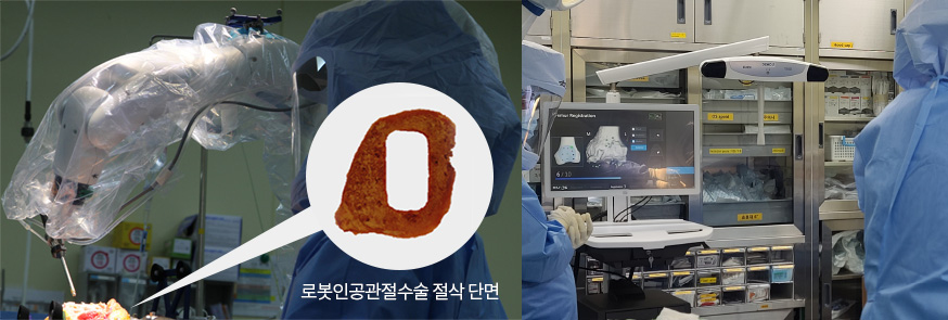 로봇인공관절수술 절삭 단면